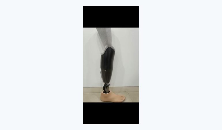 Below-knee prosthesis with a carbon fibre socket fitted at Limbgenixx