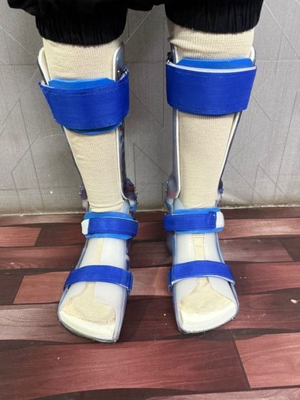 Custom AFO pair worn by a patient, front view, fitted at Limbgenixx