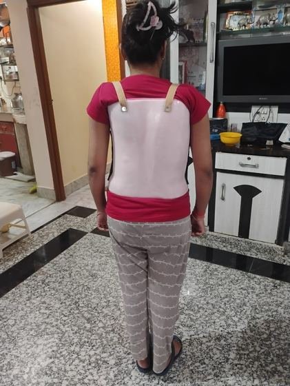 Custom TLSO spinal orthosis fitted to a patient at Limbgenixx