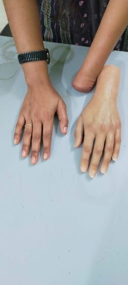 Custom silicone cosmetic prosthetic hand shown beside the sound hand