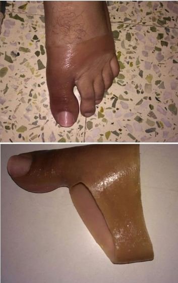 Silicone partial foot prosthesis and toe filler made at Limbgenixx