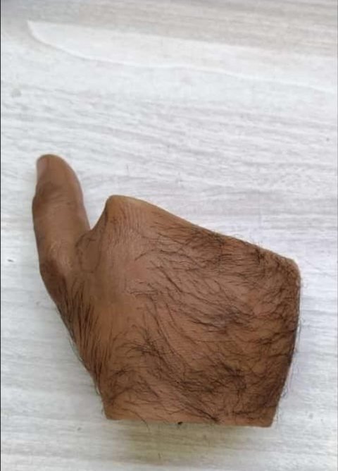 Silicone partial hand prosthesis in a deeper brown tone with implanted hair, shaped to leave the wearer’s own thumb free