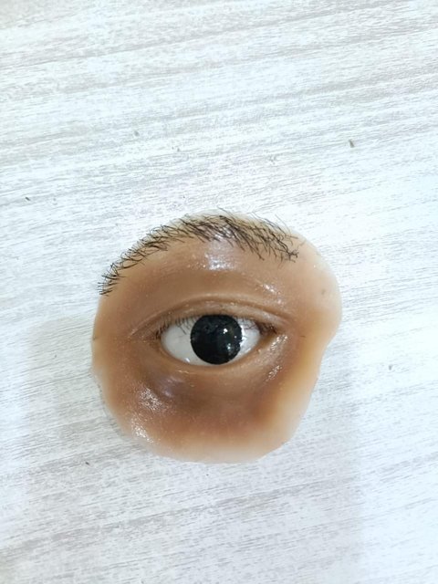 Silicone orbital prosthesis comprising an eye, eyelids with lashes and a hair-implanted eyebrow set into a skin-toned silicone surround