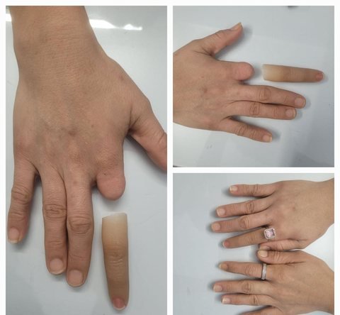 Three photographs comparing a silicone finger prosthesis with the wearer’s own hand, showing the amputation site and the finished match