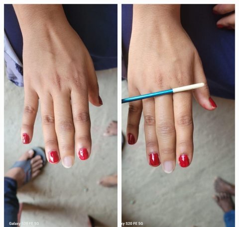 Two photographs of a hand wearing a silicone finger prosthesis whose nail has been painted to match the red polish on the wearer’s own nails