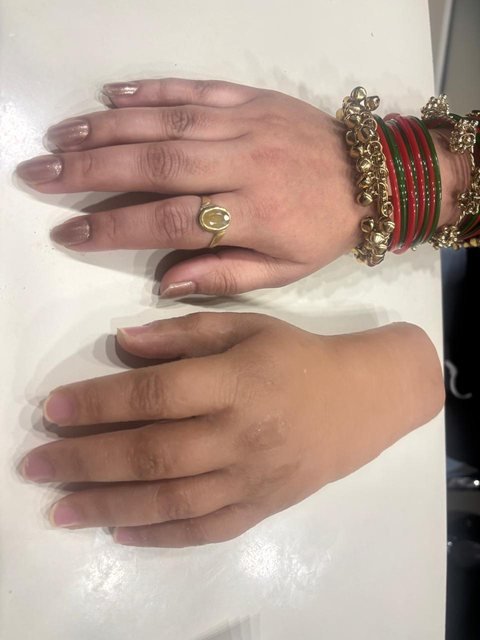 A silicone hand prosthesis photographed next to the wearer’s own hand so the two skin tones can be compared side by side