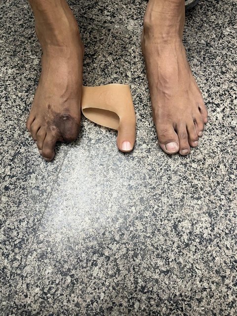 A silicone big toe prosthesis placed between a foot with a healed toe amputation and an unaffected foot, showing the colour and size match